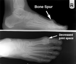 hallux limitus rigidus